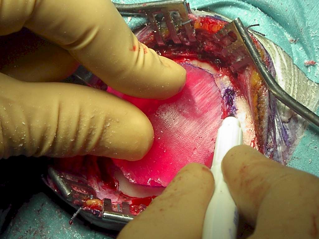 Cranioplastica new MAGAZINE