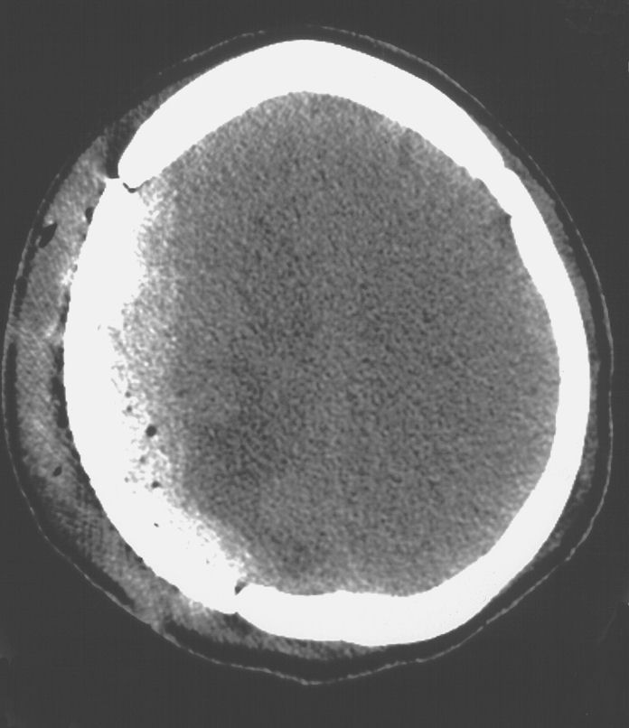 Cranioplastica new MAGAZINE