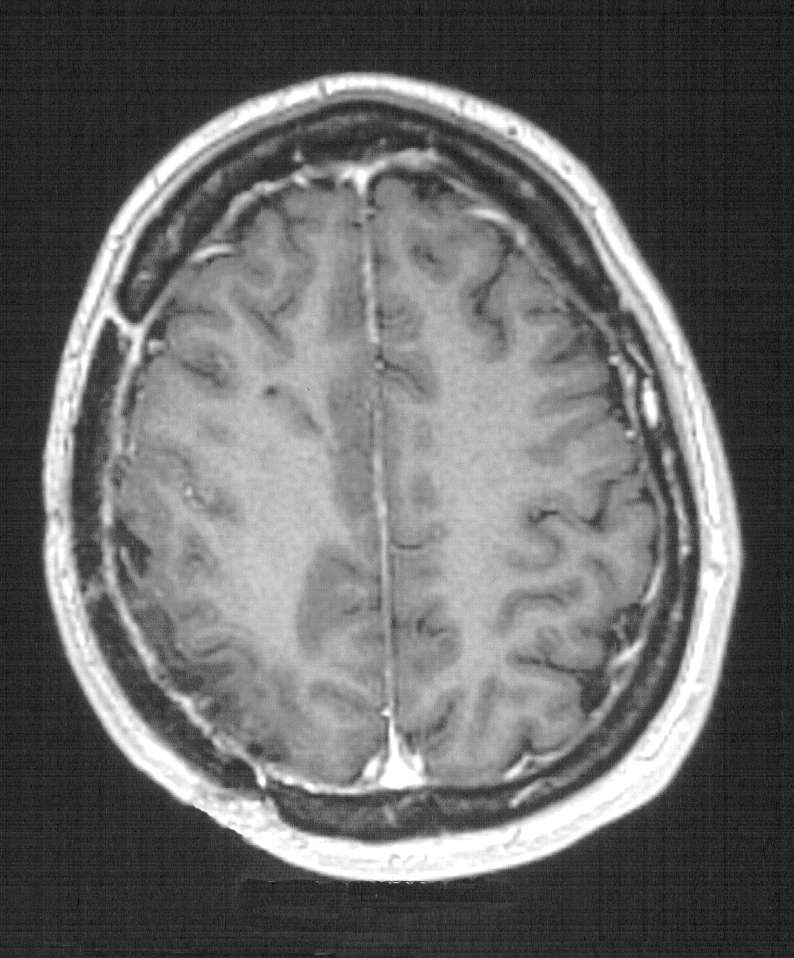 Cranioplastica new MAGAZINE