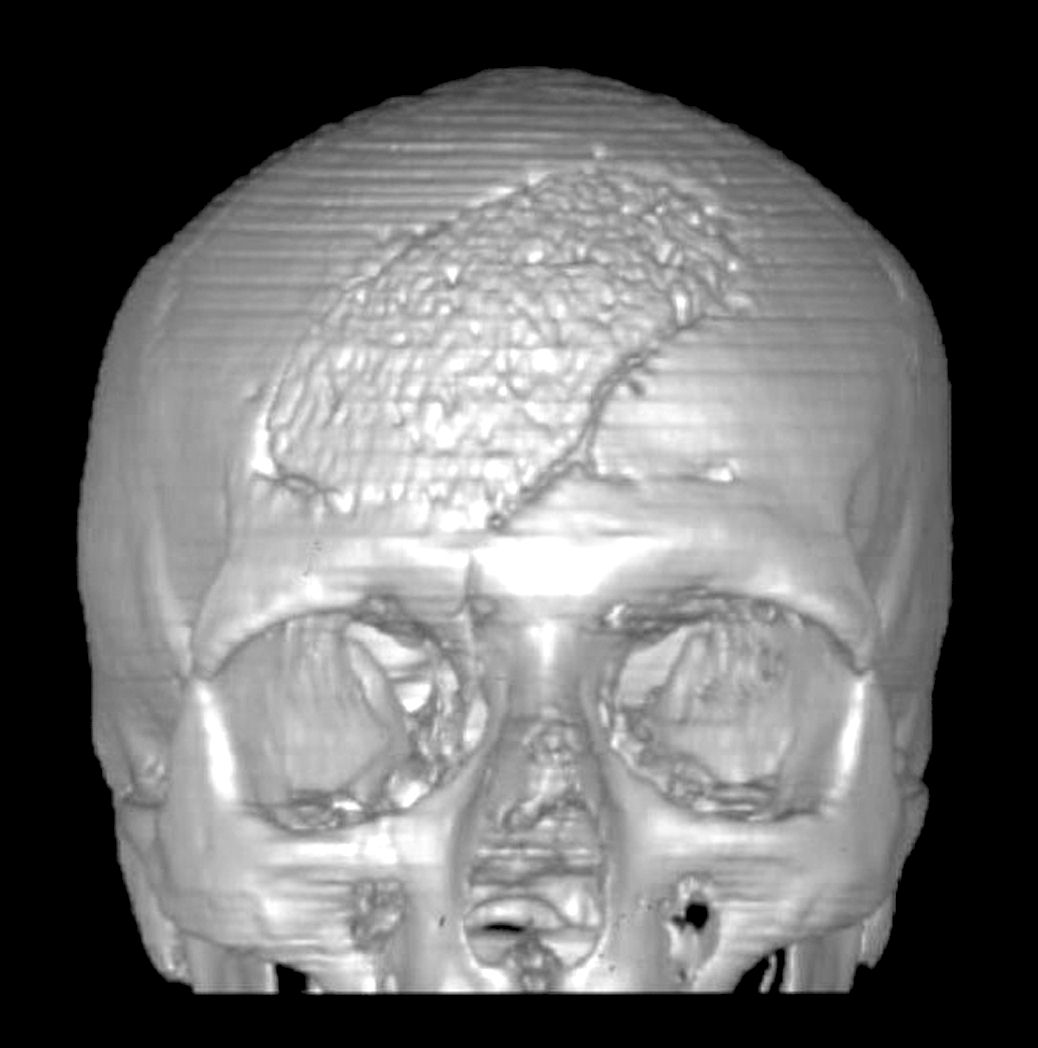 Cranioplastica new MAGAZINE