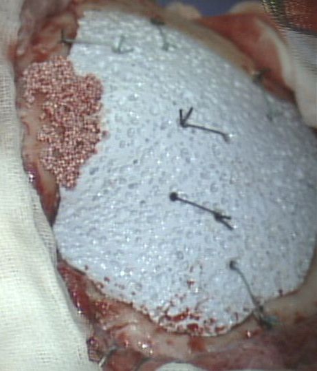 Cranioplastica new MAGAZINE