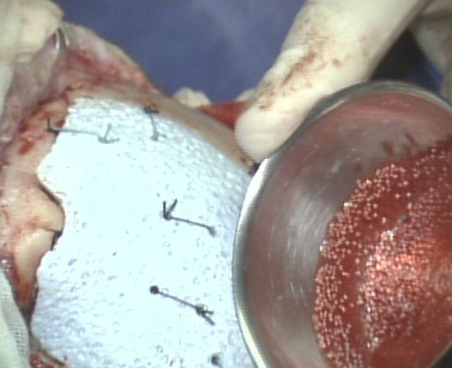 Cranioplastica new MAGAZINE