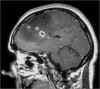 glioma-maligno.jpg (50733 byte)