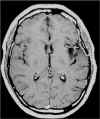 glioma-post.jpg (46554 byte)