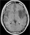 glioma-pre.jpg (41415 byte)
