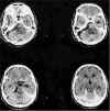 meningioma base post.jpg (59239 byte)